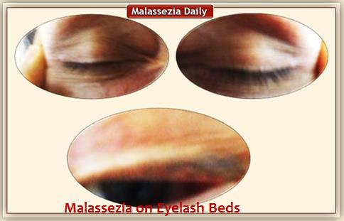 Malassezia on Eylashes 1 MD
