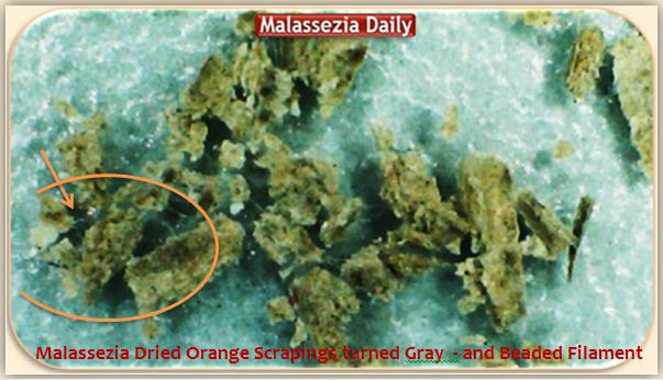 Malassezia Beaded Filament in Scrapings 1 MD