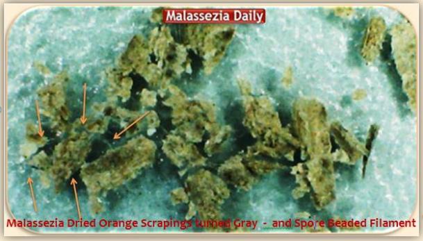 Malassezia Beaded Filament in Scrapings 2 MD