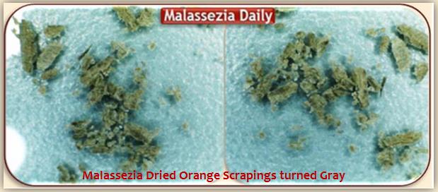 Malassezia Dried out Scrapings1 MD