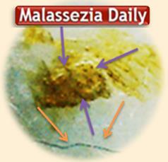 Malassezia eyelets 1-1