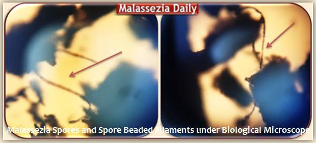Malassezia Spore- Beaded Filaments 3 MD