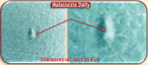 Malassezia grit in Eye 1 MD