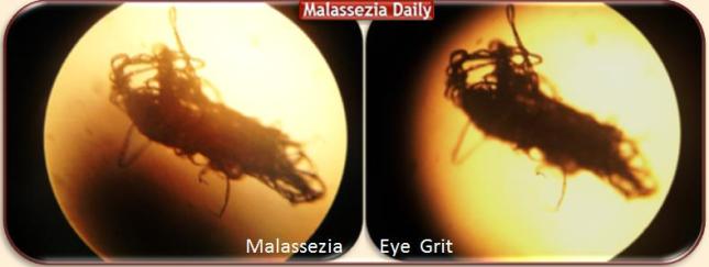 Malassezia grit in Eye 2 MD