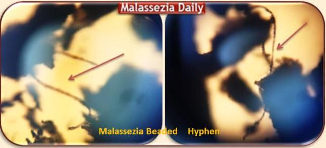 Malassezia beaded Hyphen
