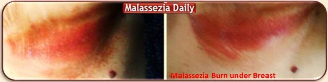 Malassezia Breast Burn 1