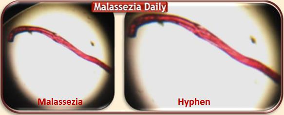 Malassezia Hypahen with Blood
