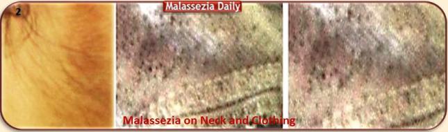 Malassezia on Body and Clothing