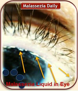 Malasezia In Eye