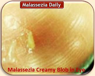 Malassezia Creamy Blob in Eye