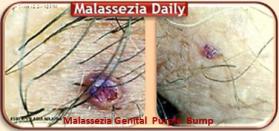 Malassezia  Genital Purple Bump