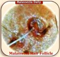 Malassezia Hair Fiolicle MD