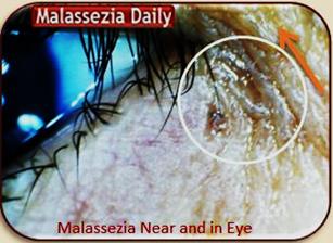 Malassezia Near and In Eye