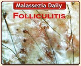 Folliculitis - Malassezia
