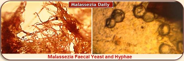 Malassezia Faecal yeast and Hyphae 1 MD