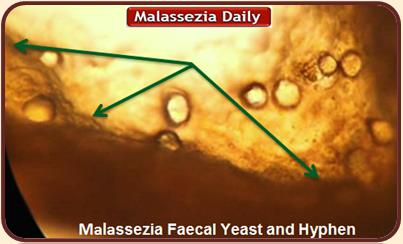 Malassezia Faecal yeast and Hyphae 2 MD