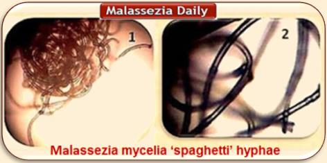 Malassezia Mycelia Hyphae MD