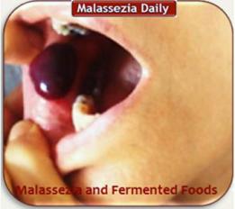 Malassezia - Fermented Foods1 MD