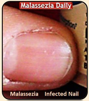 Nail Infection 3